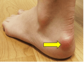 Síndrome de Haglund