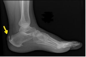 Figura 3. Radiografia simples mostra uma proeminência óssea proeminente na face posterossuperior da tuberosidade do calcâneo.
