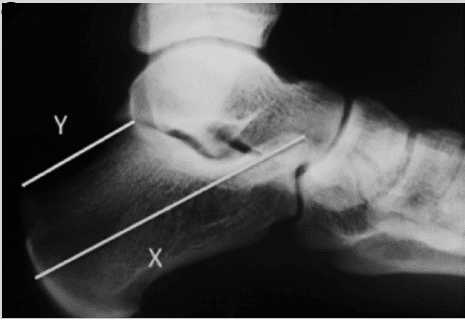 Figura 4. Medidas do calcâneo na síndrome de Haglund.