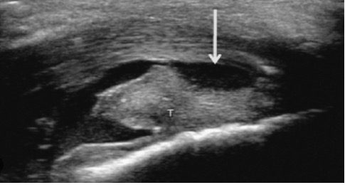 Figura 6. Bursite retrocalcânea e do calcâneo.