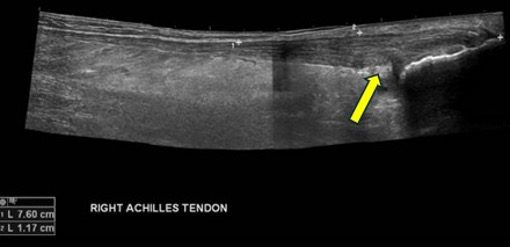 Figura 7. Edema distal do tendão calcâneo. A gordura de Kager parece ecogênica (seta). Imagem cortesia de Radiopedia.org