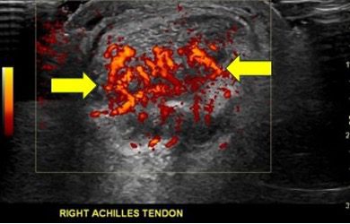 Figura 8. Hiperemia do tendão calcâneo, gordura e bursa no Doppler de amplitude.