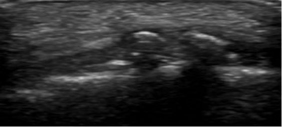 Figura 9. Bursite retrocalcânea. Imagem cortesia de Radiopedia.org