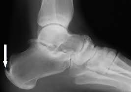 Síndrome de Haglund